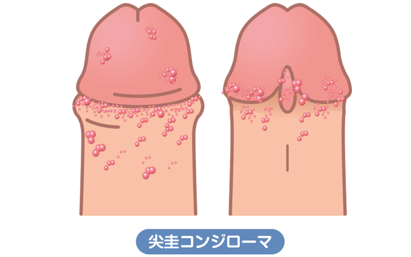 尖圭コンジローマ
