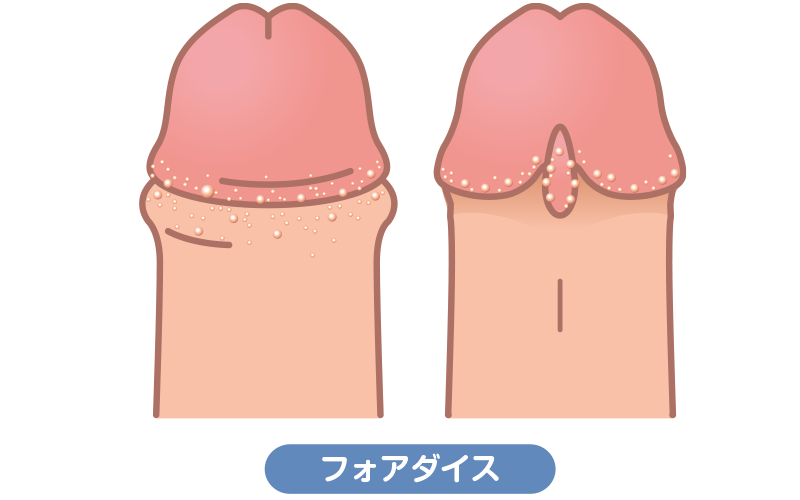 フォアダイス